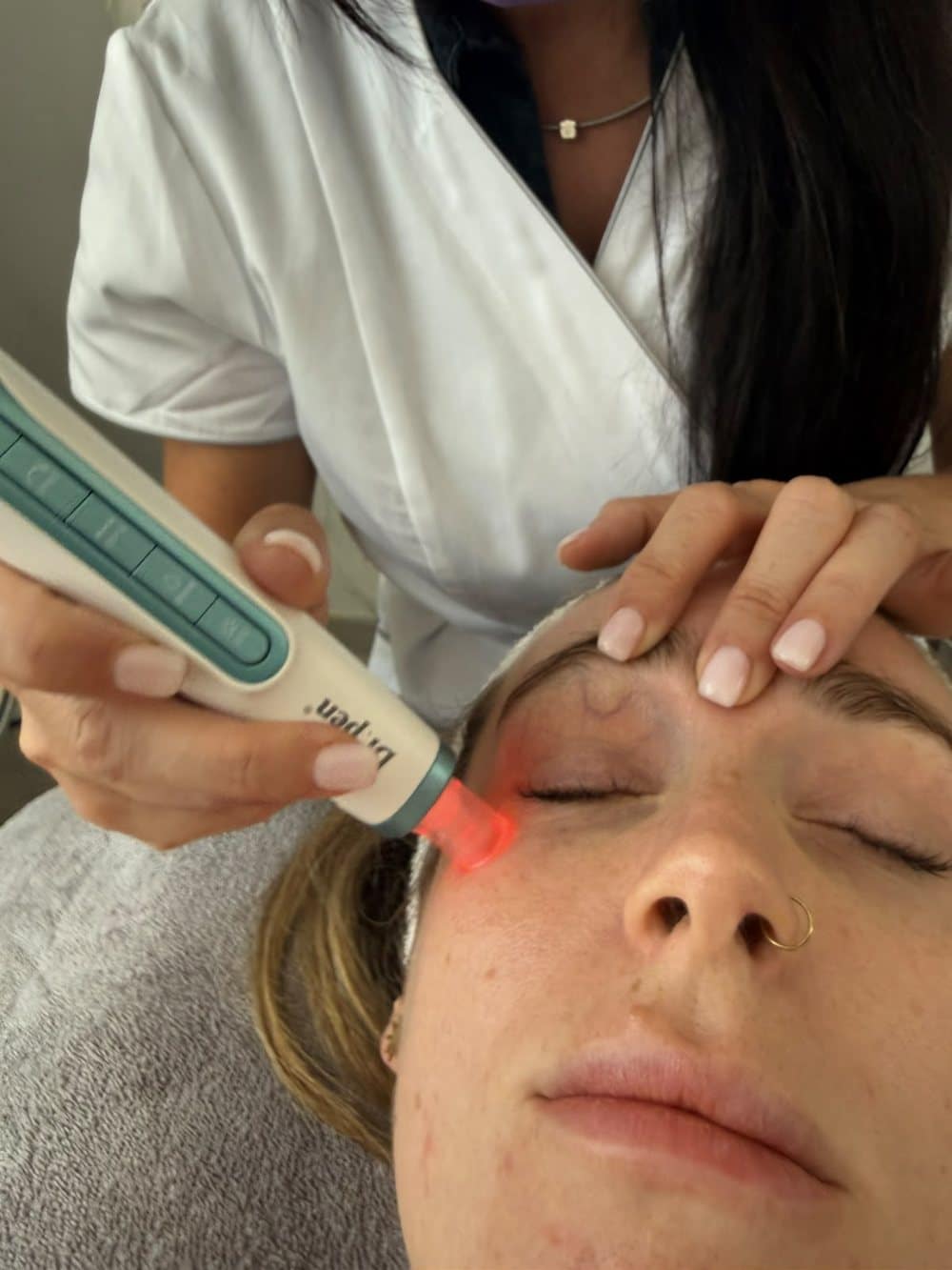 Tratamiento de exosomas con Dermapen en El Albir Tratamiento de exosomas con Dermapen en El Albir